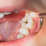 DO I HAVE A CAVITY?