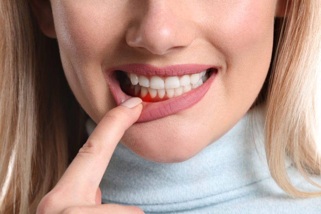 Stages Of Periodontal Disease