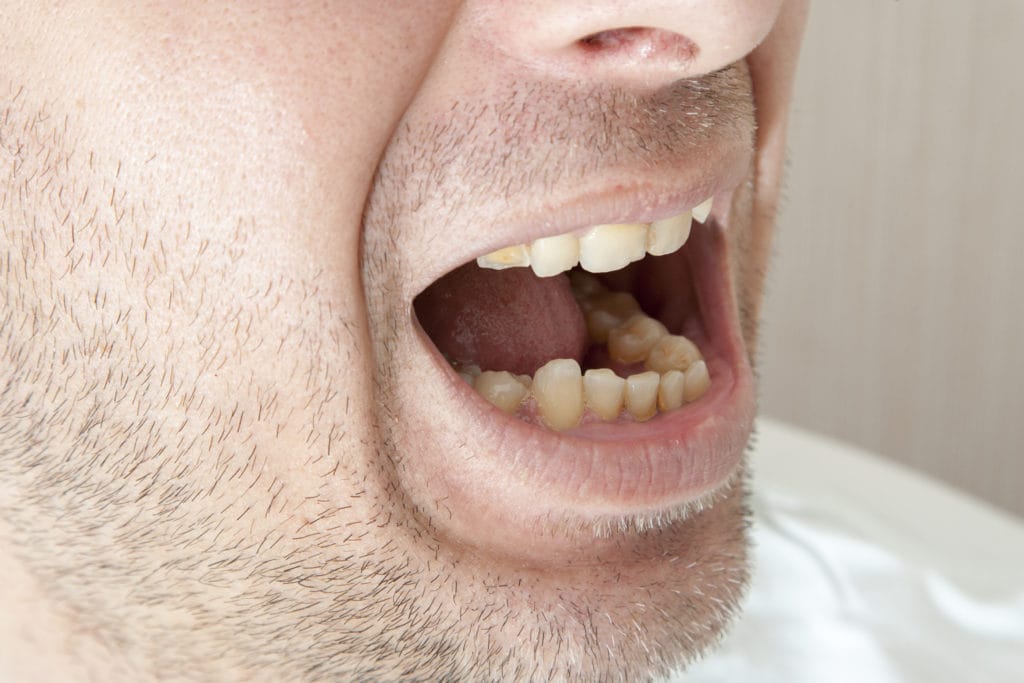 Are My Bleeding Gums Normal?