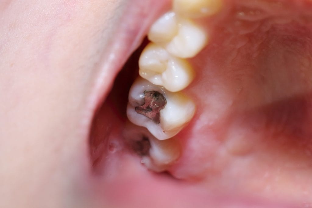 Should You Replace A Filling?
