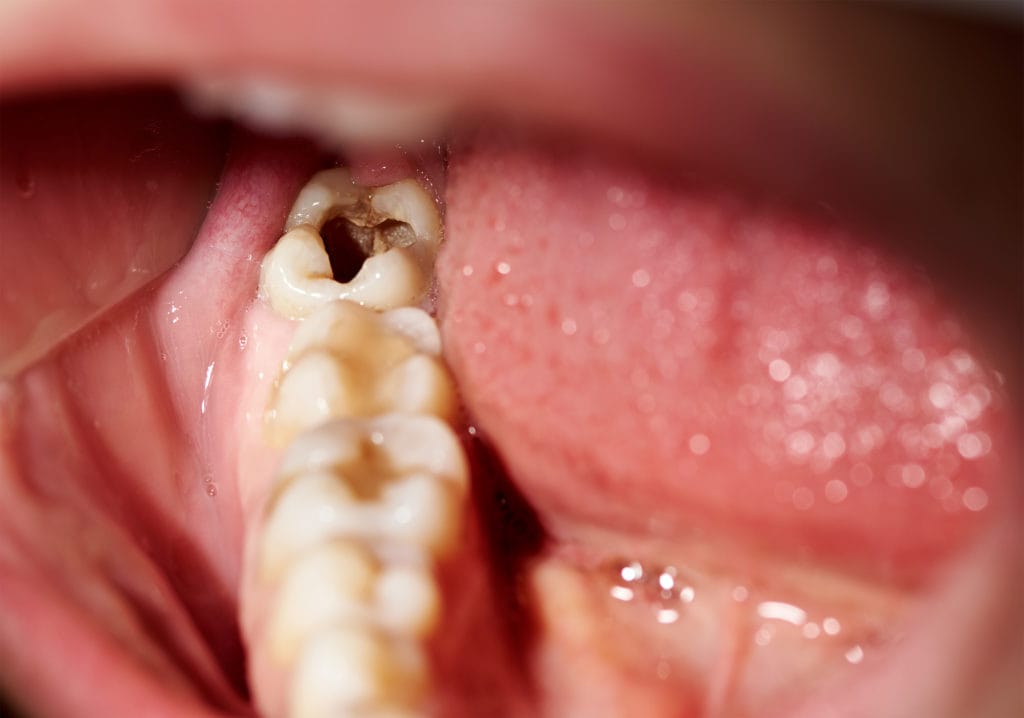 Don’t Wait To Treat That Cavity!